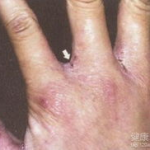 引起疥疮的原因,接触传播、个人卫生与免疫力低下的双重影响